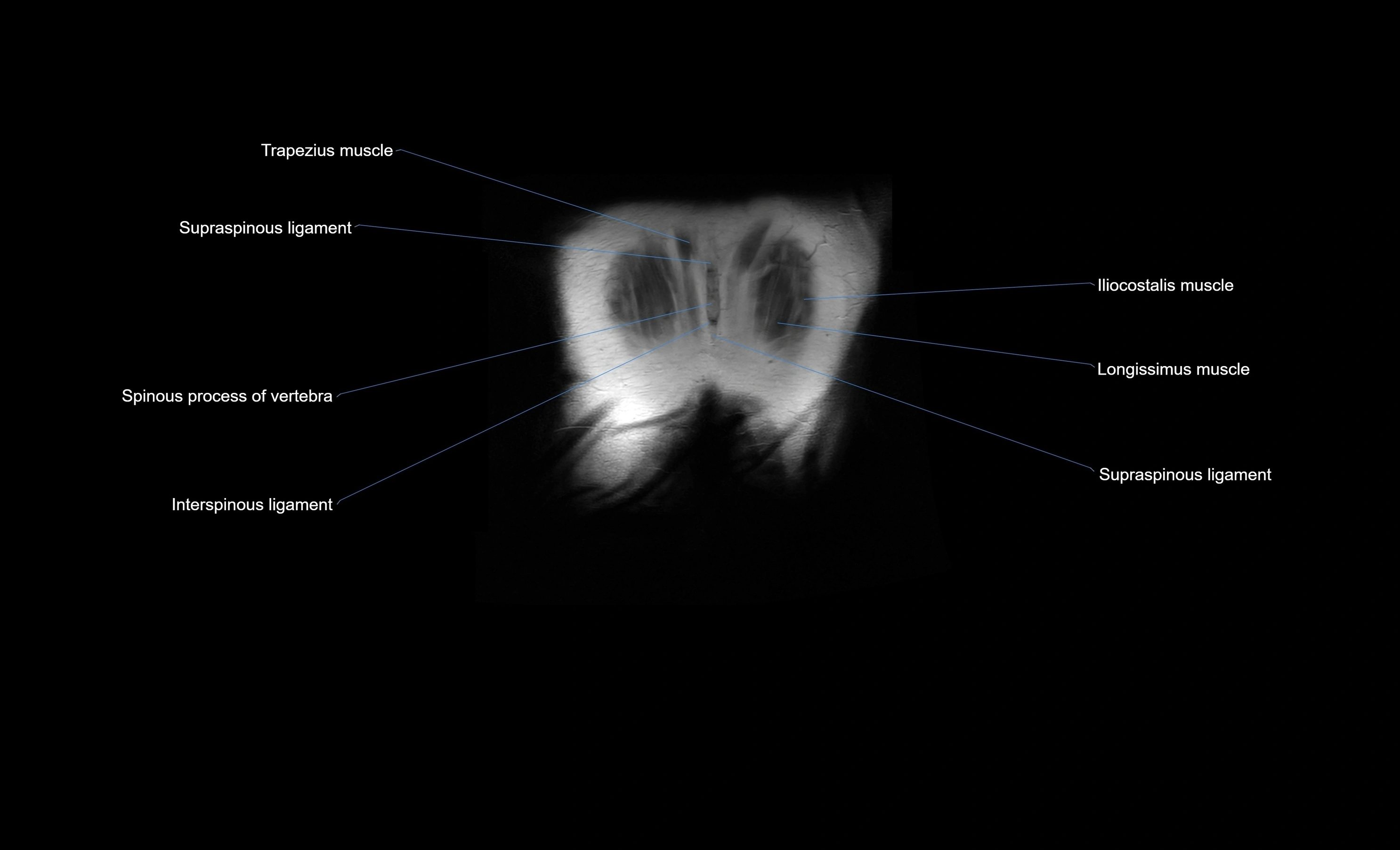 MRI Abdomen coronal labelled cross sectional anatomy radiology  image-img-00001-00057.webp